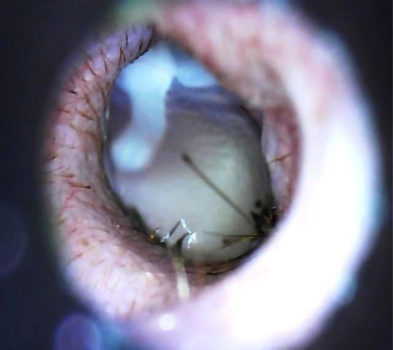 otoscopia-videoscopia